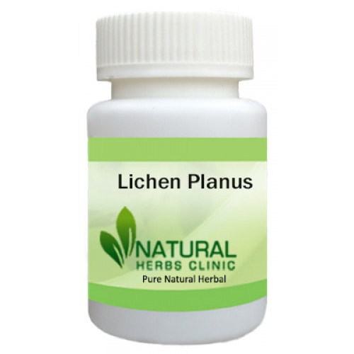 Herbal Produt for Lichen Planus